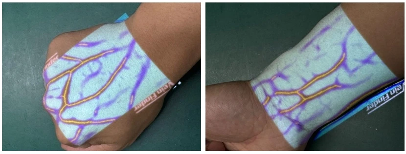 china vein finder device